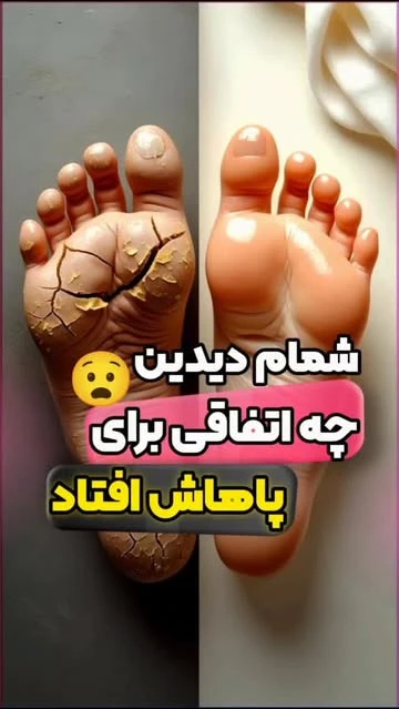 اسپری ترک پا راکو