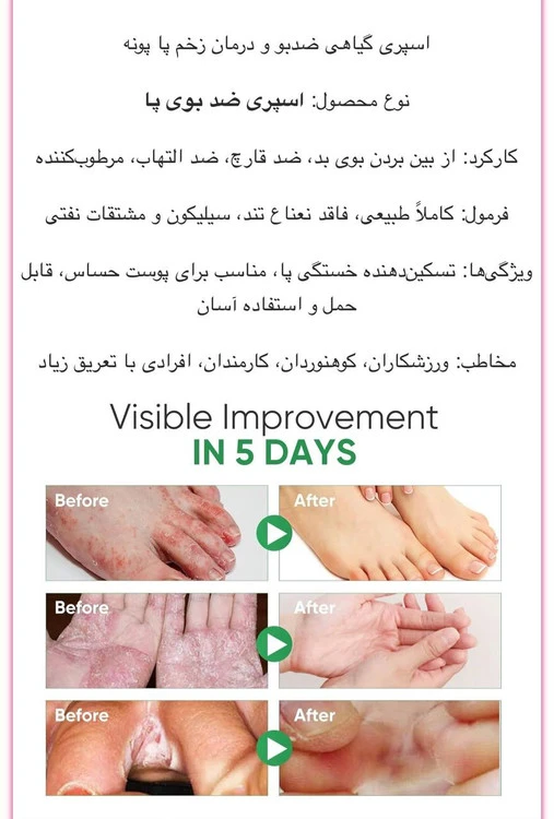 اسپری گیاهی ضد بو و درمان زخم دست و پا پونه hanel