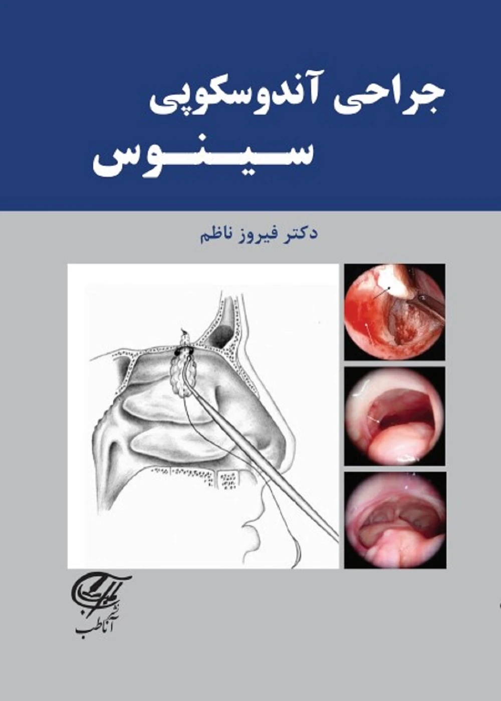 جراحی آندوسکوپی سینوس