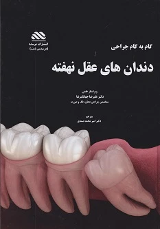 جراحی دندان های عقل نهفته