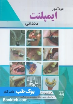 خودآموز ایمپلنت دندانی