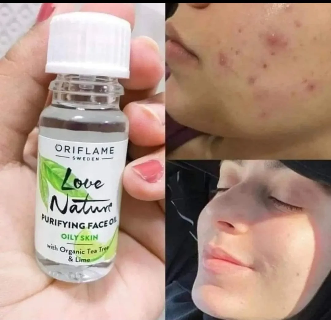 روغن ضد جوش تی تری درخت چای و لیمو لاونیچر اوریفلیم اورجینال