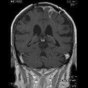 فروش پروژه دسته بندی و بازاریابی تصاویر پزشکی mri براساس محتوا با استفاده از ماشین بردار پشتیبان و تکنیک الگوریتم ژنتیک