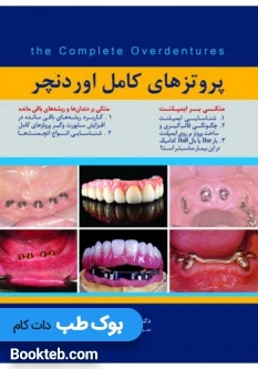 پروتزهای کامل اوردنچر