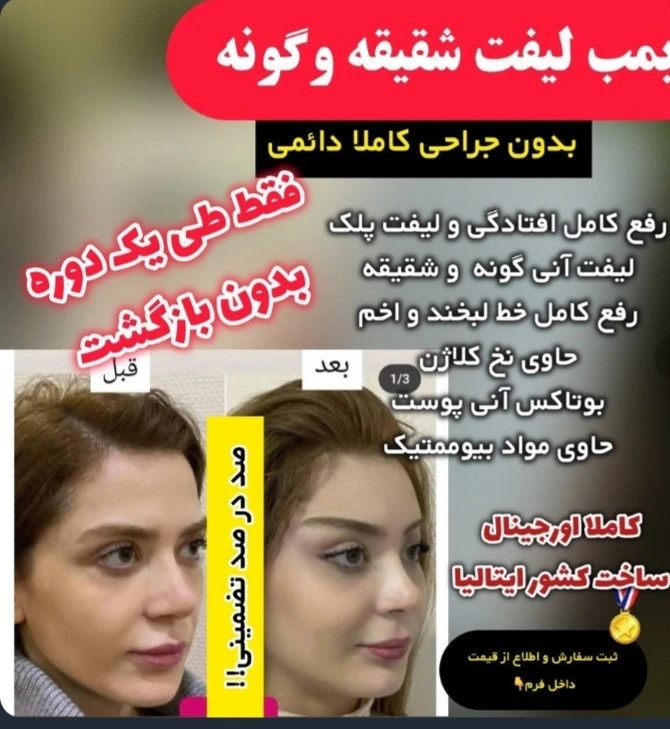 چسب لیفت شقیقه تاثیر صد درصدی برای زیبایی و جوانساز