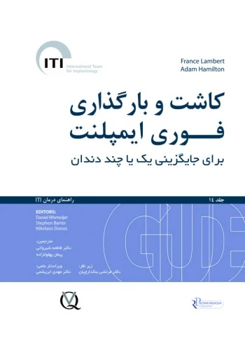 کاشت و بارگذاری فوری ایمپلنت برای جایگزینی یک یا چند دندان جلد 14