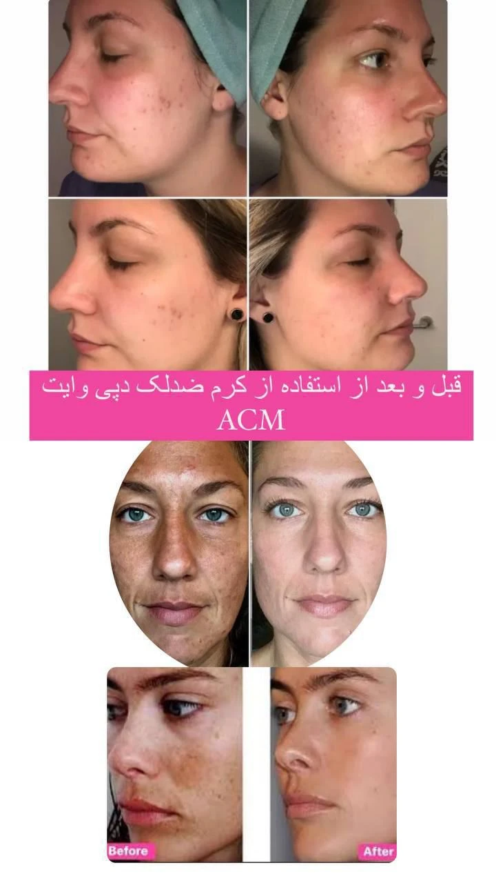 کرم ضد لک ای سی ام دپی وایت اورجینال