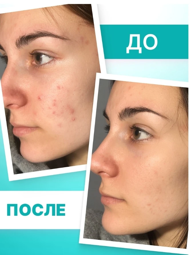 کرم موضعی TeenSkin برای پوست‌های مشکل‌دار فابرلیک اورجینال
