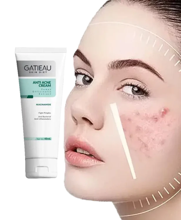 کرم ژل آنتی آکنه(ضد جوش و ضد لک)گاتیو بیوممتیک