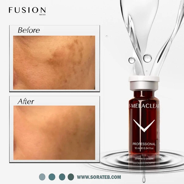 کوکتل درمان لکه های قهوه ای فیوژن F-MELACLEAR 10ml